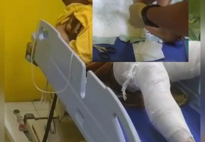 Akibat Bermain Meriam Spirtus Dua Bocah Di Sampang Terbakar.